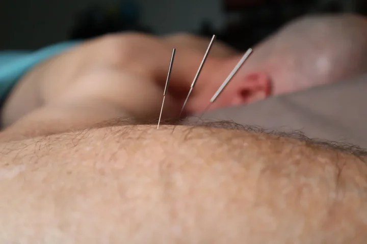 Agulhas de acupuntura aplicadas na região do ombro
